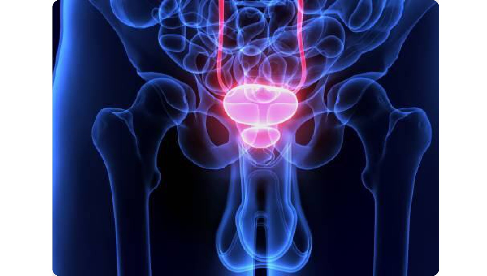 Cáncer de vejiga